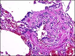 Small airway with obstruction in bronchiolitis obliterans - Photo used with permission from European Respiratory Society Journals