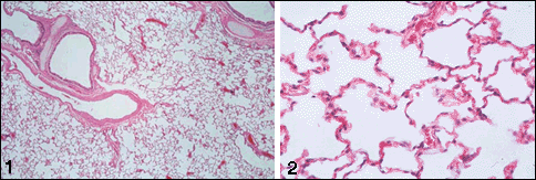 Normal Lung - Photo courtesy of Uniformed Services University of the Health Sciences