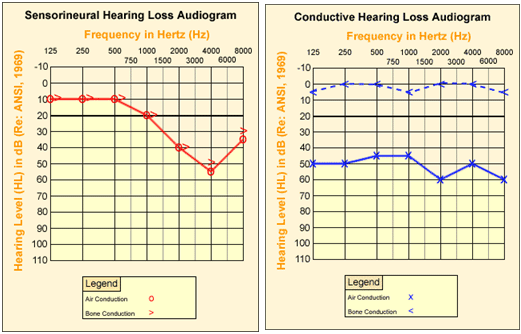 Audiograms - sensorineural hearing loss, and conductive hearing loss audiogram.